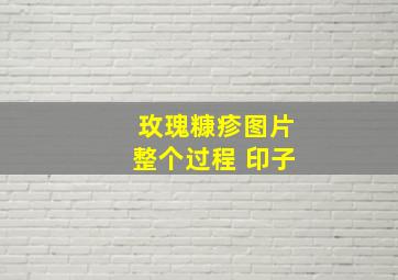 玫瑰糠疹图片整个过程 印子